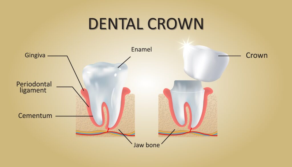 Dental Cap vs Crown comparison