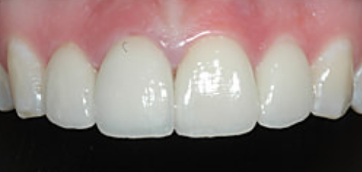 Porcelain crown used in dental cap vs crown treatments
