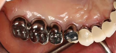 Metal crown example in dental cap vs crown treatments