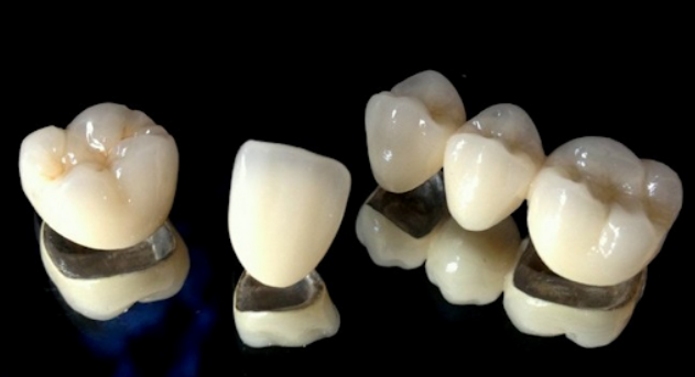 Porcelain fused to metal crown used in dental cap vs crown cases