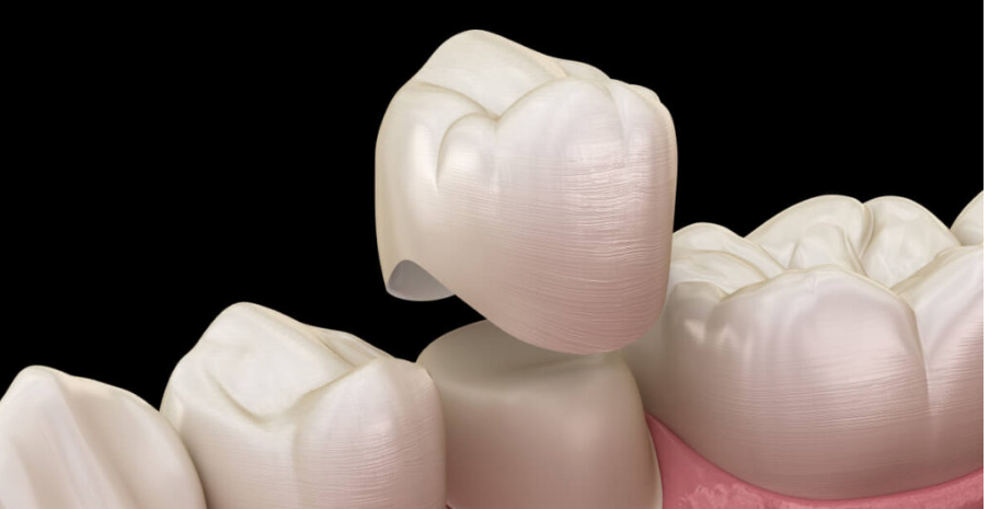 Ceramic crown used in modern dental cap vs crown procedures